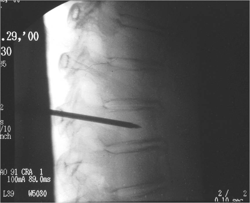 Jamshidi needle in vertebral body.jpg